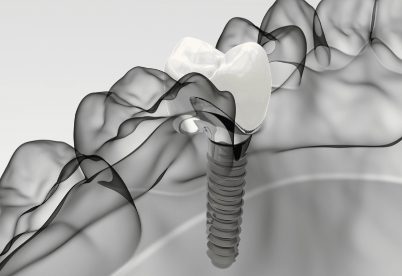 Single Dental Implants Sandbach Patients Gain Increased Access to More Consultation Slots at Crown Bank Dental